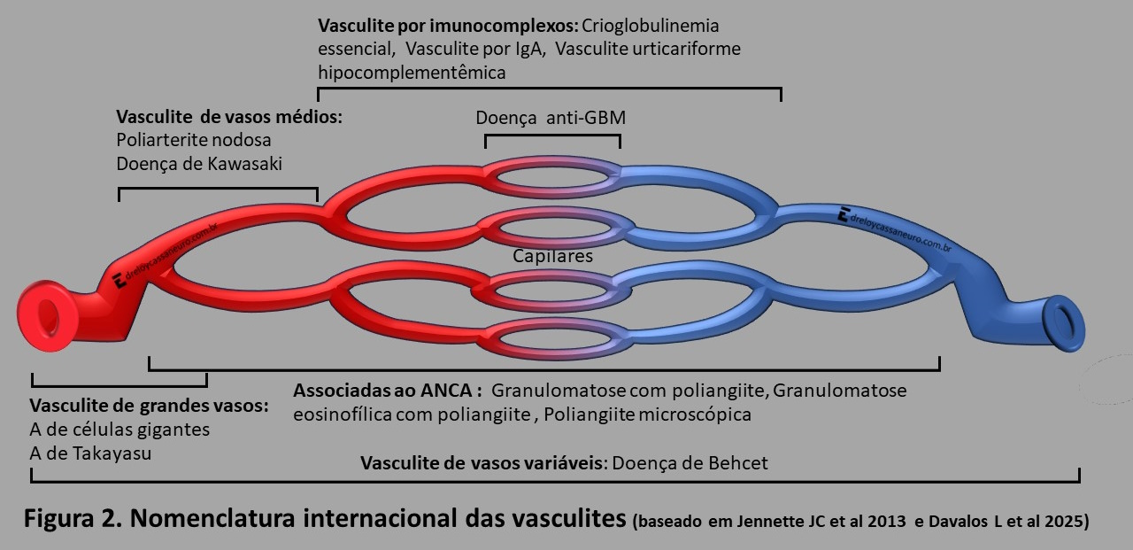 Neuropatia Multifocal: Neuropatia das Vasculites - Dr. Eloy Cassa
